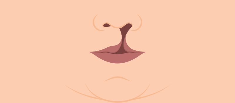 Cleft Lip and Palate: Causes, Diagnosis, & Treatment