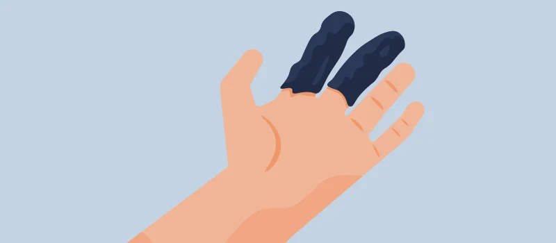 Understanding Raynaud's Syndrome: Symptoms, Causes, and Treatments