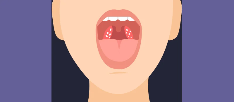 Tonsil Stone Prevention: Your Complete Guide