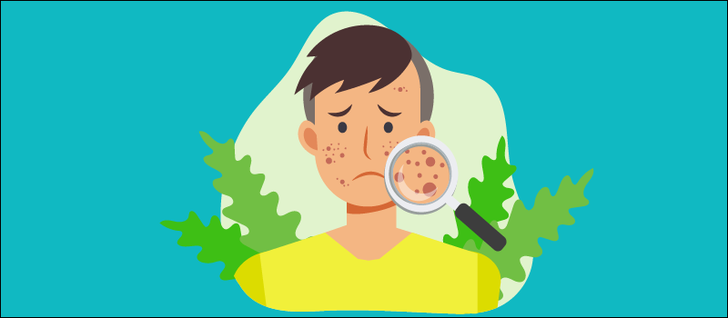 What Is Cystic Acne & How Can You Treat It Effectively?